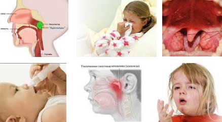 Как вылечить аденоиды в носу у ребенка
