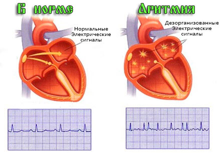 Мерцательная аритмия сердца 3