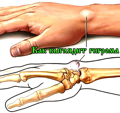 Гигрома пальца руки лечение народными средствами без операции отзывы thumbnail