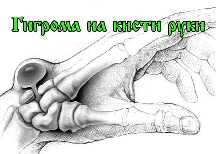 Гигрома на ноге лечение народными средствами отзывы